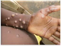 Monkeypox: A Comprehensive Overview